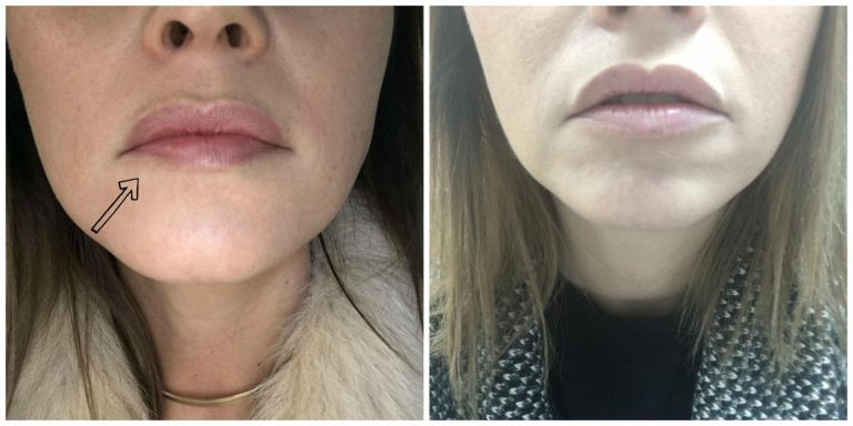 Botox, Acide hyaluronique : j&rsquo;ai fait corriger ma bouche!