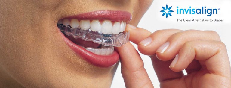 Invisalign : mon appareil dentaire à 40 ans!